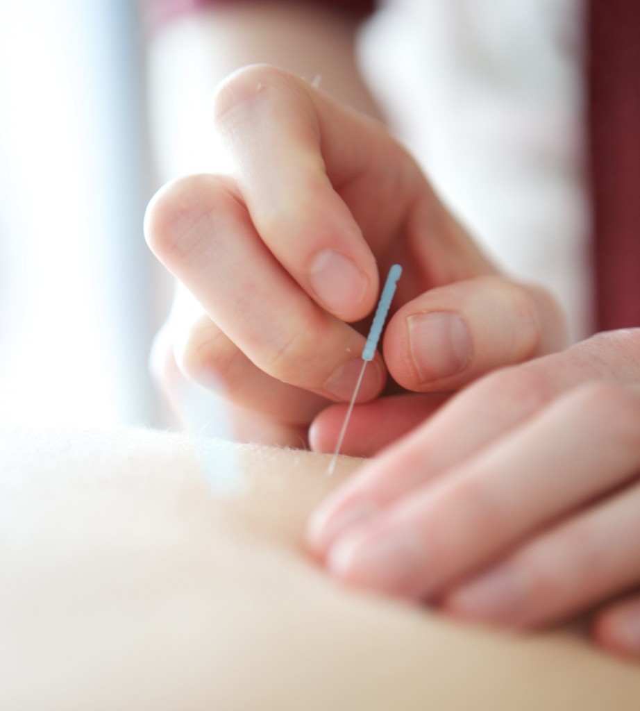 Dry Needling 1 Acupunctuur Dry-Needling