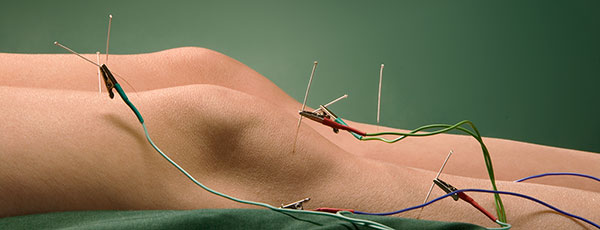Electro Acupunctuur 1 Electro Acupunctuur